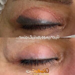 بهترین خدمات تتو ریمووال در تهران | مرکز ریموو تاتو در تهران ❤️