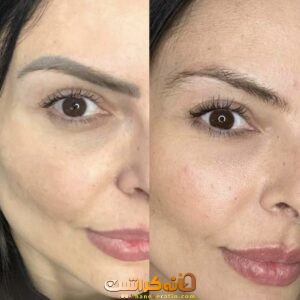 بهترین خدمات تتو ریمووال در جنوب تهران | مرکز ریموو تاتو در جنوب تهران ❤️