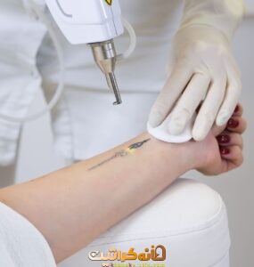 بهترین خدمات تتو ریمووال در شمال تهران | مرکز ریموو تاتو در شمال تهران ❤️