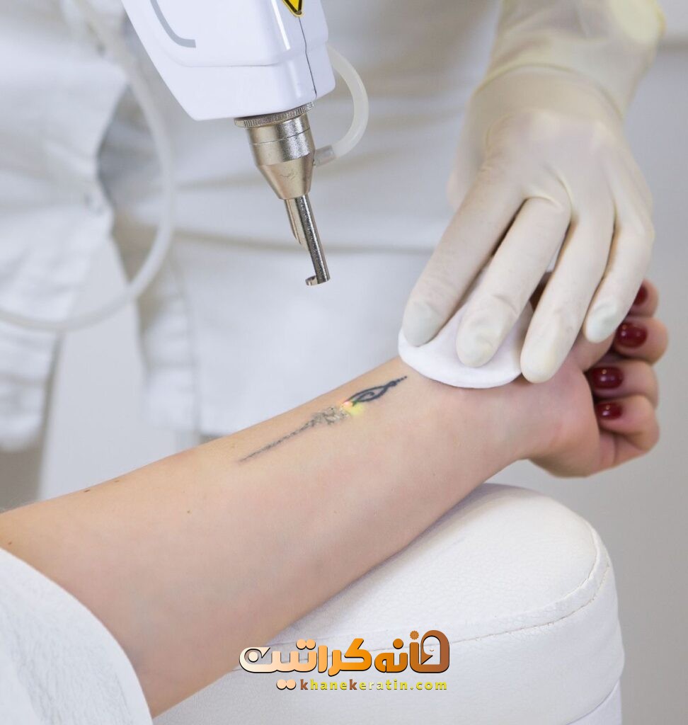 بهترین خدمات تتو ریمووال در شمال تهران | مرکز ریموو تاتو در شمال تهران ❤️