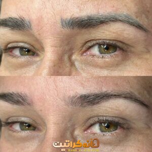 بهترین خدمات تتو ریمووال در غرب تهران | مرکز ریموو تاتو در غرب تهران ❤️