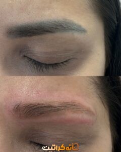 بهترین خدمات تتو ریمووال در شرق تهران | مرکز ریموو تاتو در شرق تهران ❤️